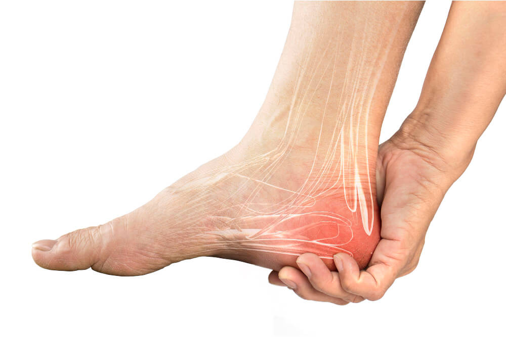 Plantar Fasciitis