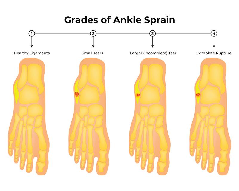 ankle pain